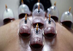حجامت توسط افراد غیر متخصص خطرناک است