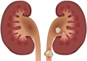 سنگ کلیه چه علائمی دارد؟